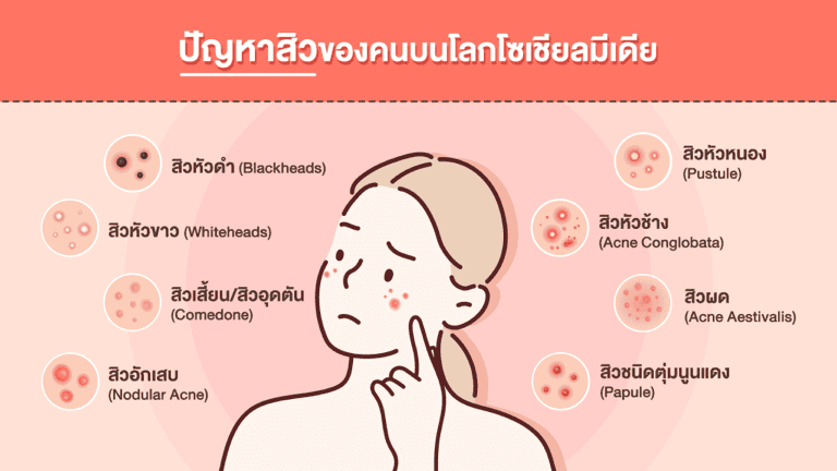 ปัญหาสิวแต่ละประเภทของคนบนโลกโซเชียลมีเดีย